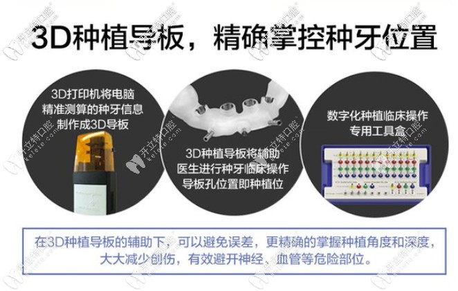 做種植牙安全嗎