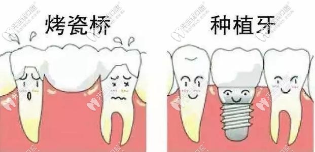 烤瓷牙和種植牙對(duì)比 烤瓷牙和種植牙對(duì)比