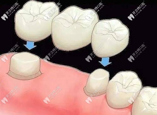 連橋冠修復(fù) 連橋冠修復(fù)