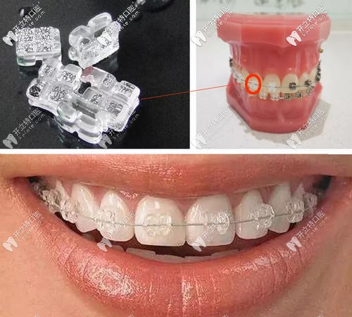 陶瓷半隱形牙套