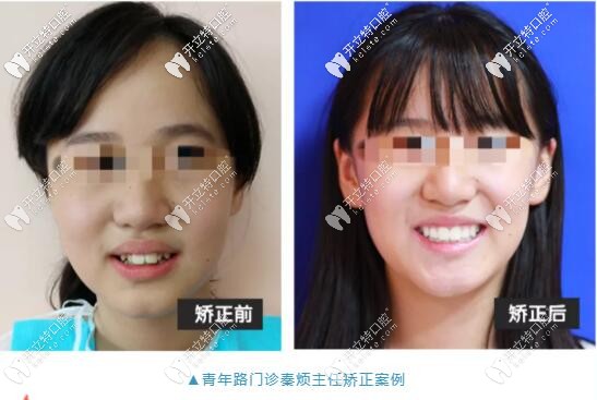 武漢愛尚大眾口腔正畸案例