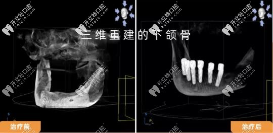 <!--<i data=20240703-sp></i>-->曙康全口all-on-6種植x線片前后對比