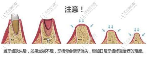 牙槽骨量不足帶來的危害