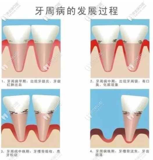 牙周病的發(fā)展過程