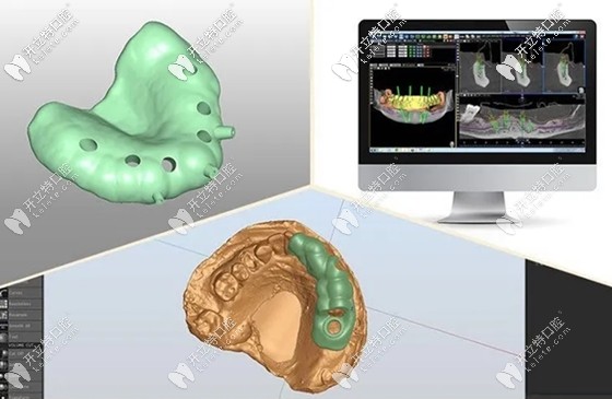 岑燕梅醫(yī)生淺談MAC智能種植牙 岑燕梅醫(yī)生淺談MAC智能種植牙