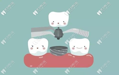 想在天津市做全口種植牙必看,費(fèi)用貴不貴自己體會喲~