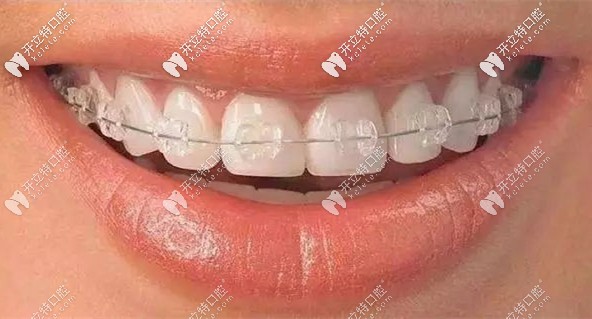 冰晶托槽半隱形矯正器