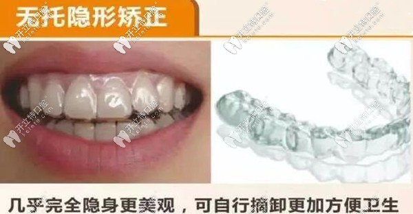 無(wú)托槽隱形矯正器