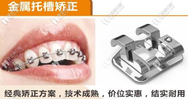 固定金屬托槽矯正器