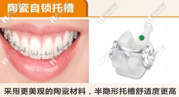 陶瓷半隱形自鎖托槽