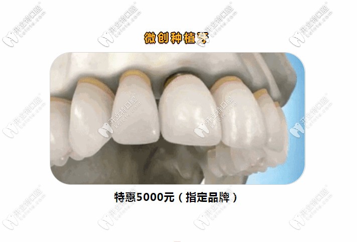 晉江維樂口腔開診期間做韓國(guó)登騰種植牙價(jià)格只需5000元起嘍!