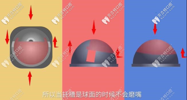 球面自鎖托槽表面力的運(yùn)動(dòng)方向