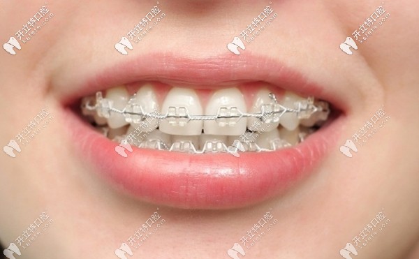 成都新橋口腔牙齒矯正價格列表