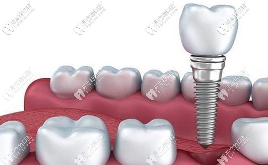 美國3I的種植體價格因不同型號而不同