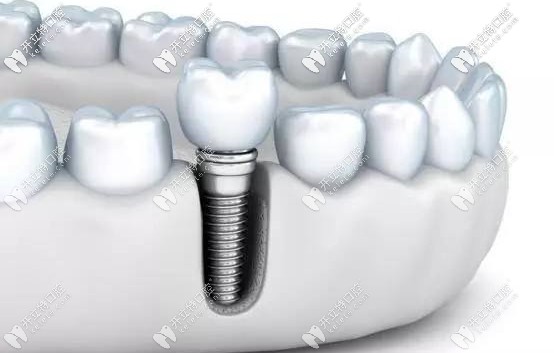同是美國3I種植體收費(fèi)差異卻很大的原因介紹