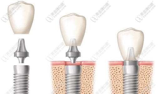 美國種植體的型號介紹