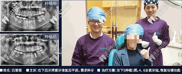 昆明尚愛韓美李兵做韓國dentium<span style=