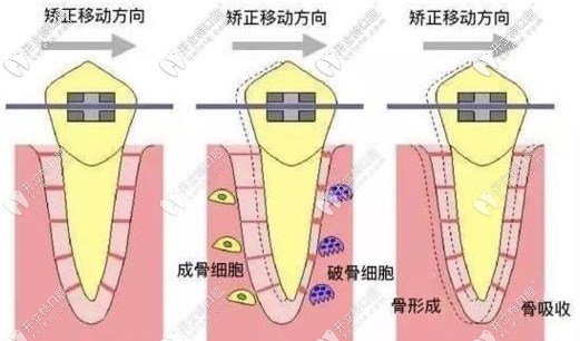 矯正過程中牙齒移動(dòng)的方向
