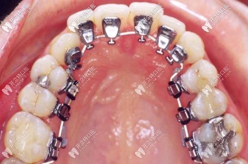 對舌側(cè)隱形矯正的介紹