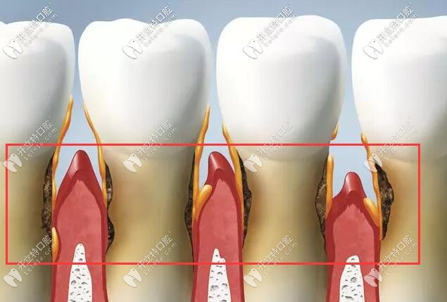 預(yù)防牙周病和牙齦萎縮的方法