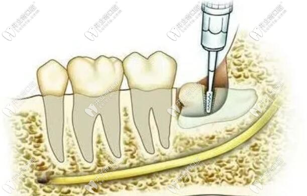 阻生式智齒拔除