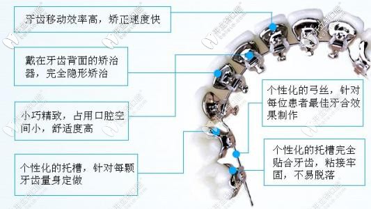 舌側(cè)矯正優(yōu)勢(shì)