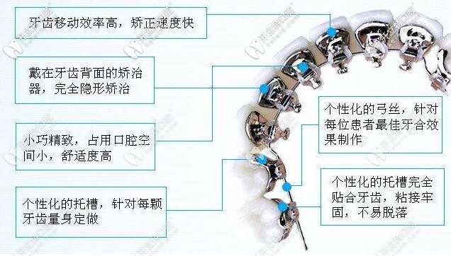 舌側(cè)矯正優(yōu)勢(shì)