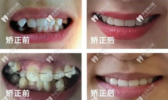 蘭州皓亞口腔正畸案例前后對比圖