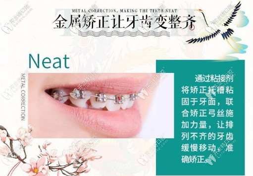 金屬矯正讓牙齒變整齊