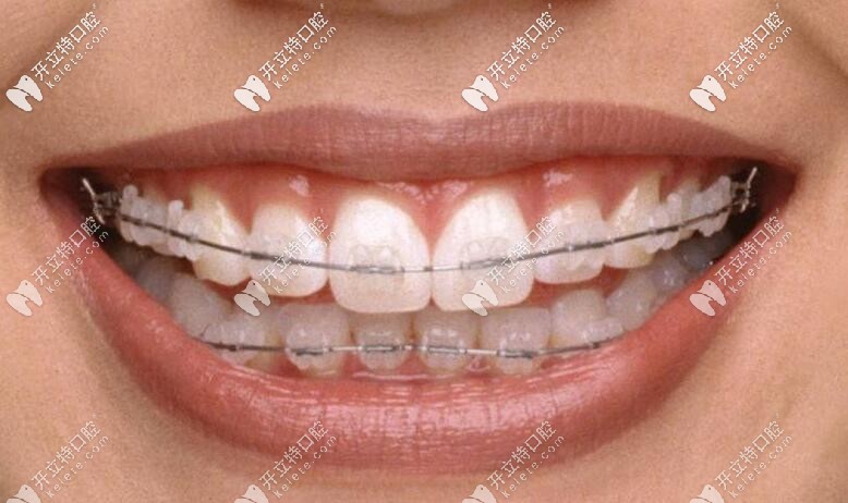 半隱形矯正器