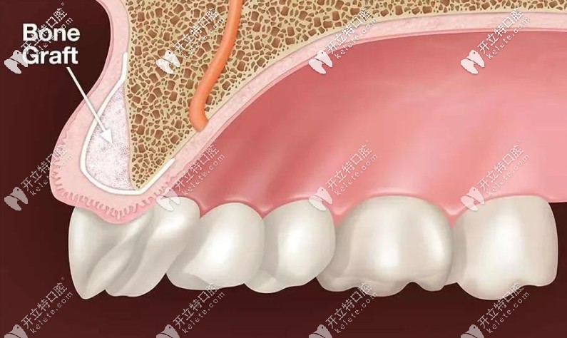 這幾種情況都是需要植骨的