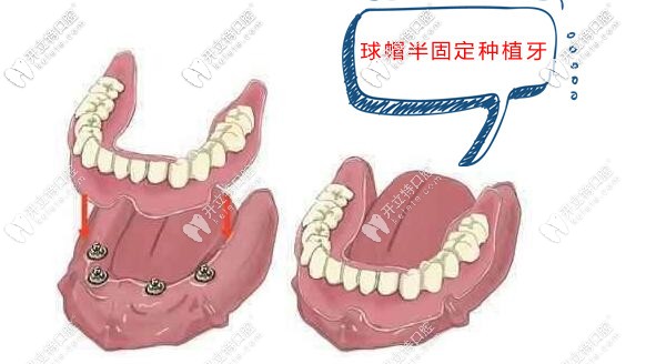 廊坊愛嘉口腔半口球帽半固定種植牙