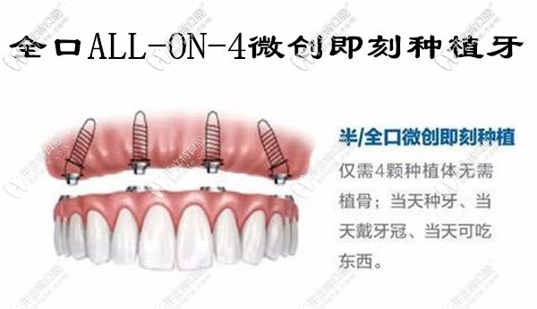廈門allon4全口微創(chuàng)即刻負(fù)重種植牙價(jià)格