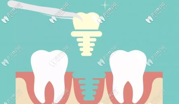 種植牙選哪個好