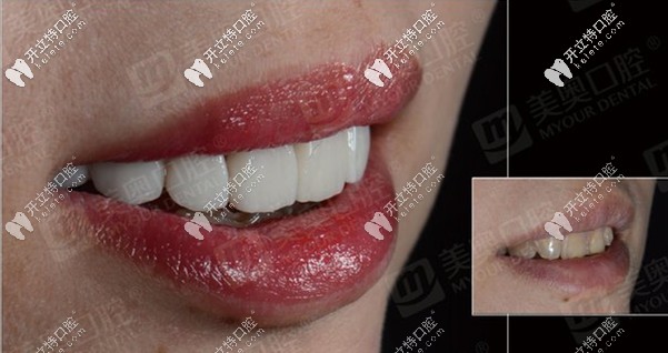 想問：重慶美奧口腔醫(yī)院做義獲嘉全瓷貼面的效果如何？