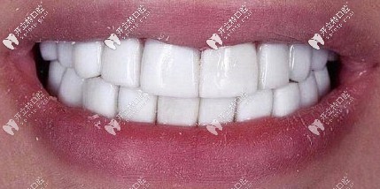 小診所做的牙齒貼面效果差強人意