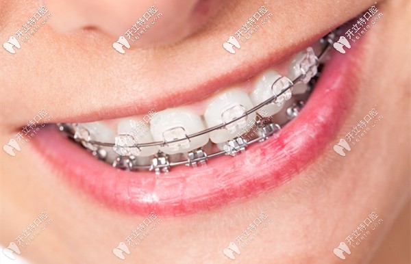 廣州好大夫口腔的正畸費用介紹