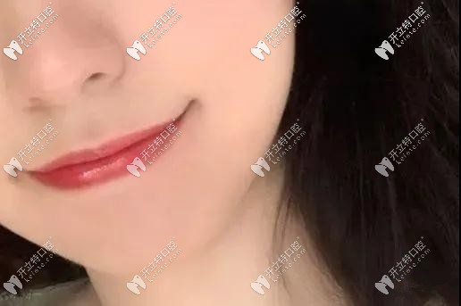 雖說還沒結(jié)束，但嘴巴已經(jīng)變好看了哦