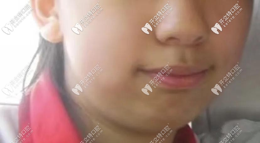 門牙突出導(dǎo)致口呼吸，下巴后縮的問題