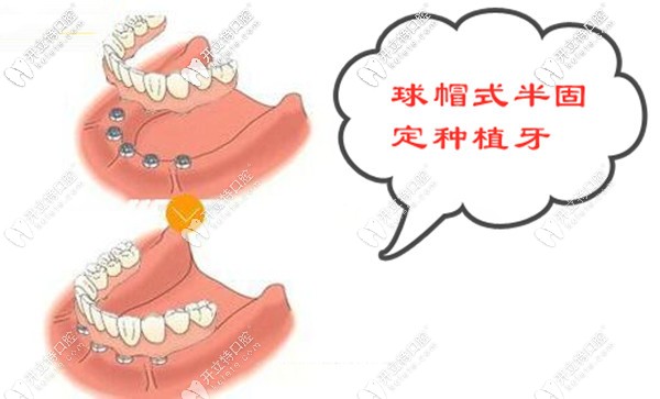 昆明德韓口腔半口球帽式半固定種植牙