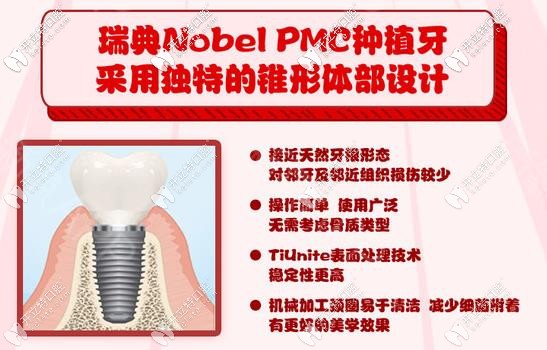 諾貝爾pmc種植體優(yōu)勢(shì)