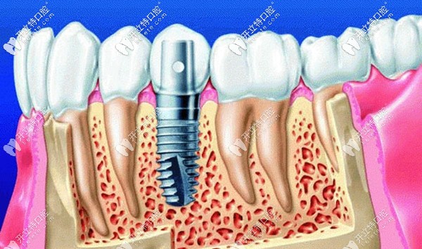 成都君臣口腔種植牙優(yōu)惠價格
