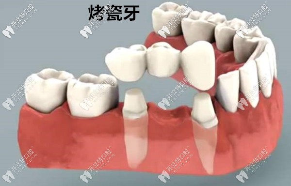 鑲牙好還是做種植牙好呢