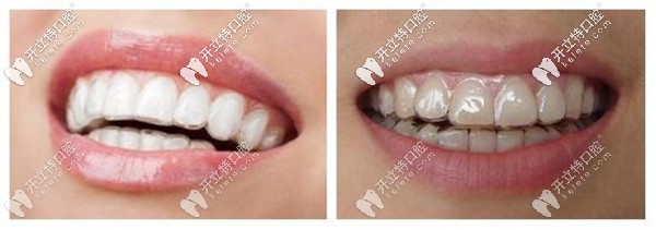 隱適美隱形牙套矯正