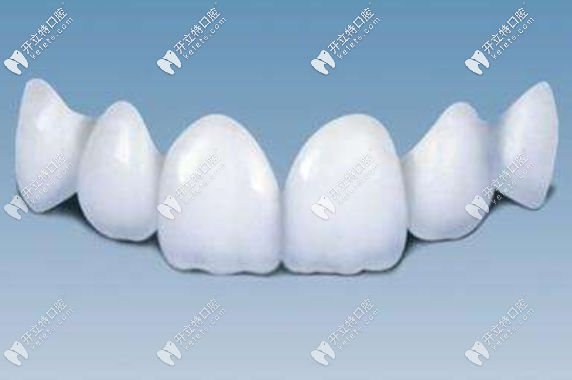 氧化鋯全瓷冠