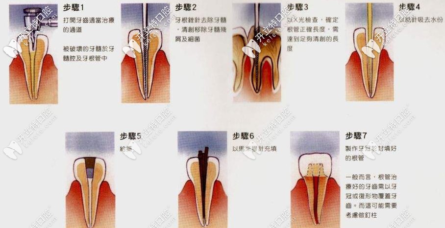 根管治療的全部過程 根管治療的全部過程