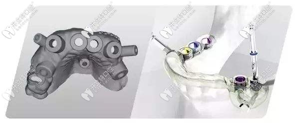 通過CAD/CAM激光掃描和CBCT實現(xiàn)導板種植