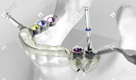 3D數(shù)字化導板種植技術(shù)