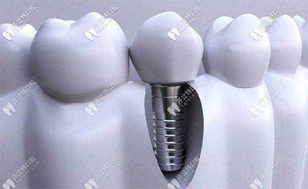 即刻種植牙和傳統(tǒng)種植優(yōu)缺點(diǎn)