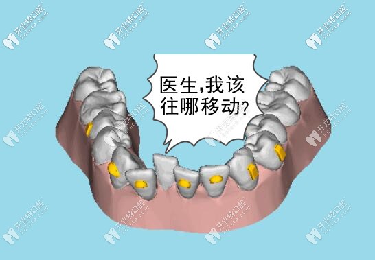牙齒矯正時(shí)移動軌跡 牙齒矯正時(shí)移動軌跡